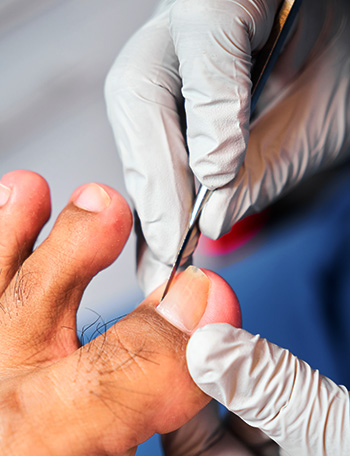 Ingrown Toenail Surgery (Partial Nail Avulsion) — thumbnail