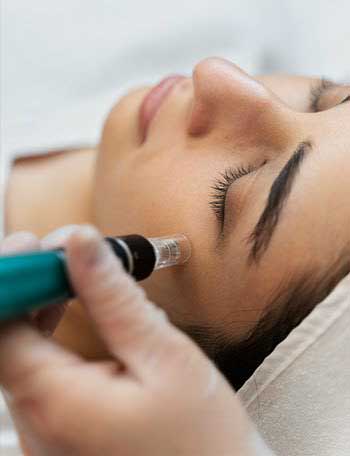 Microneedling Treatment: Uses, Benefits & Results ā thumbnail