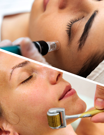 Microneedling & Dermaroller Treatment for Acne — thumbnail