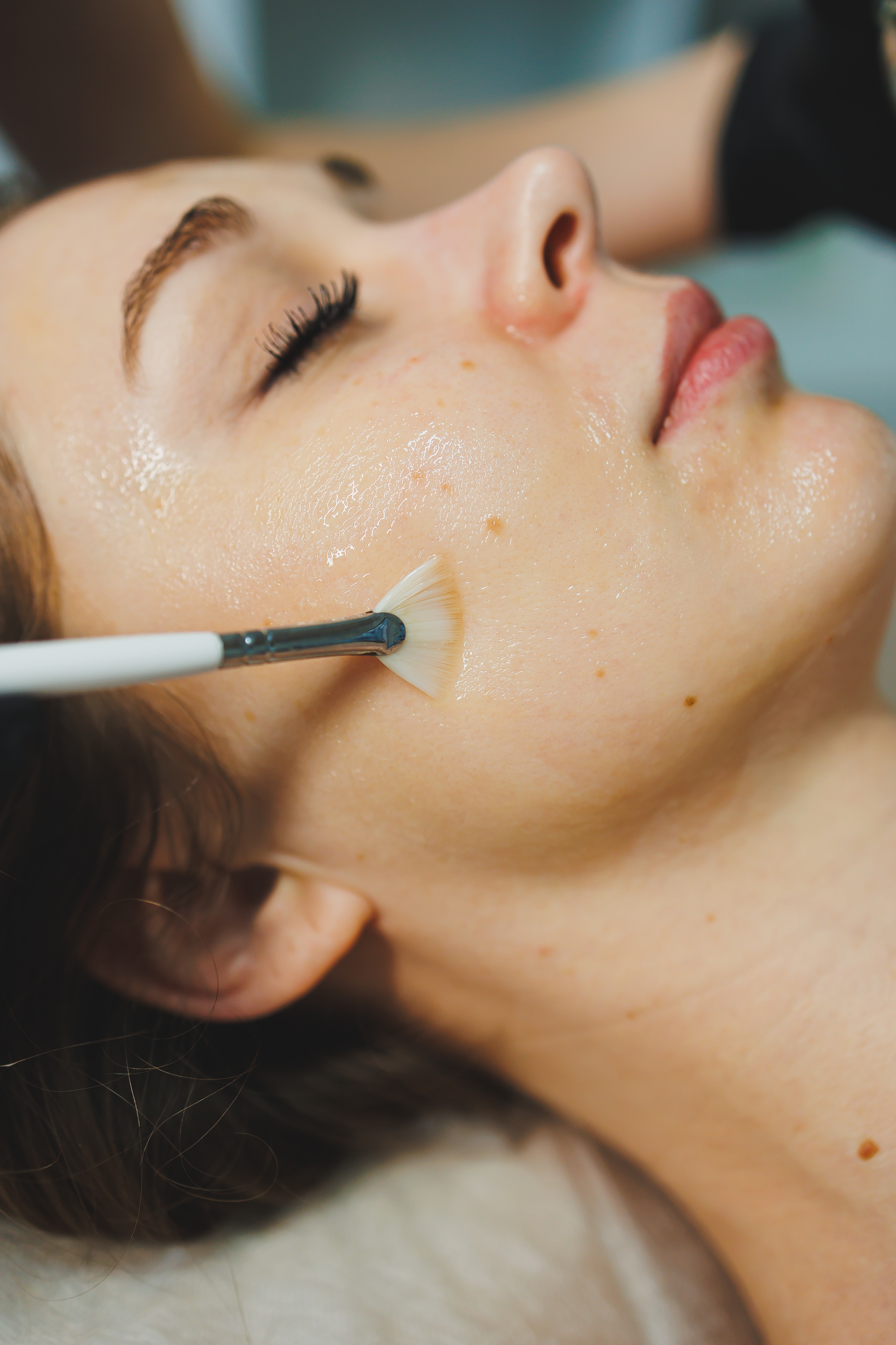 Retinol Peel for Melasma — thumbnail