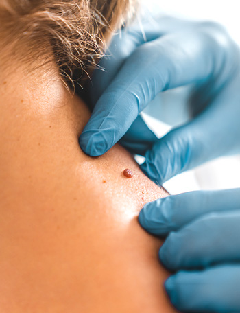 Skin Tag Removal: Treatment Options & Removal Cost — thumbnail