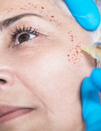 Vampire Facial - PRP Treatment for Face — thumbnail