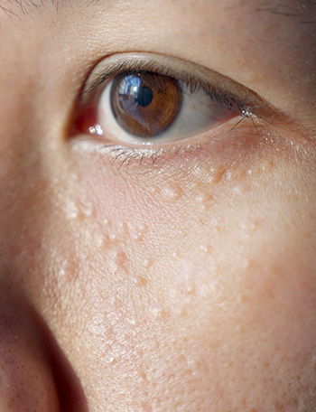 What is Milia - Causes, Treatment and Prevention — thumbnail
